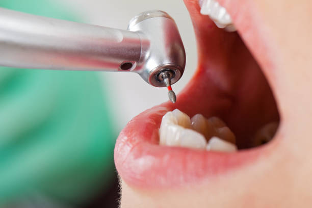 Best Emergency Tooth Extraction in Elkhorn City, KY